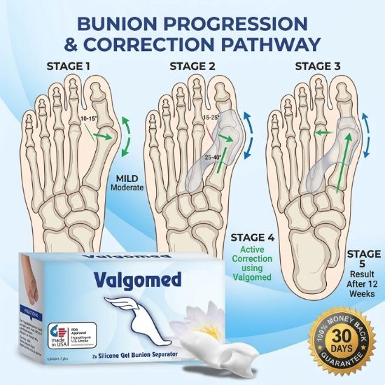Picture of Valgomed 2x Silicone Gel Bunion Hallux Valgus Separator Fixative bales Toes